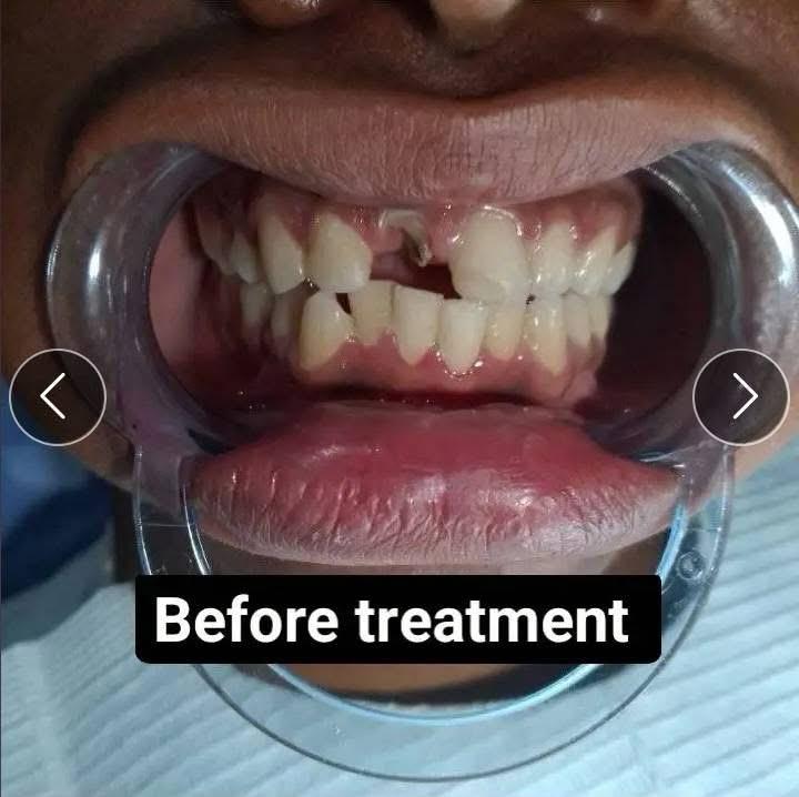Front Tooth Reconstruction – before