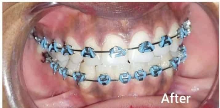 Orthodontic Braces Alignment – after