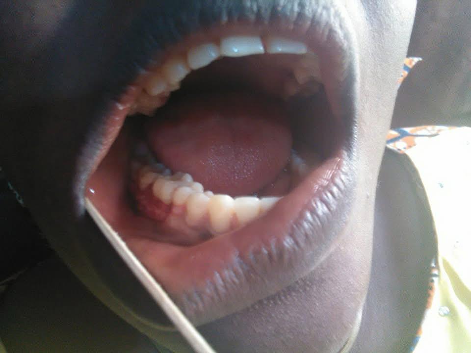 Minor Oral Surgery – after