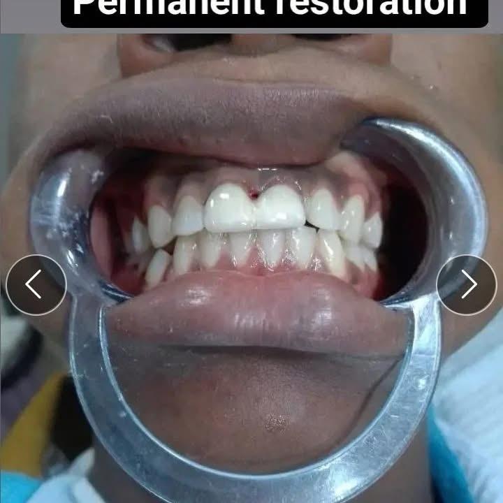 Permanent Tooth Restoration – after