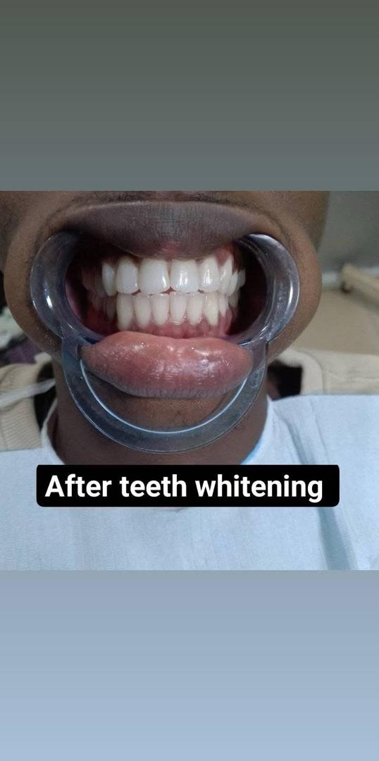 Professional Teeth Whitening – after