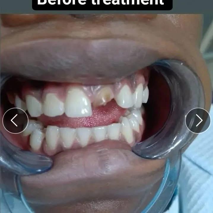 Permanent Tooth Restoration – before