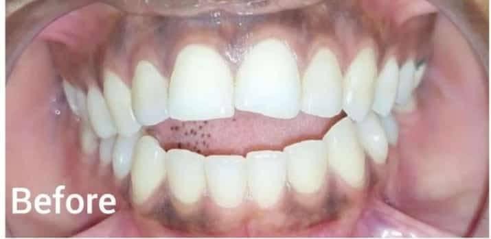 Orthodontic Braces Alignment – before