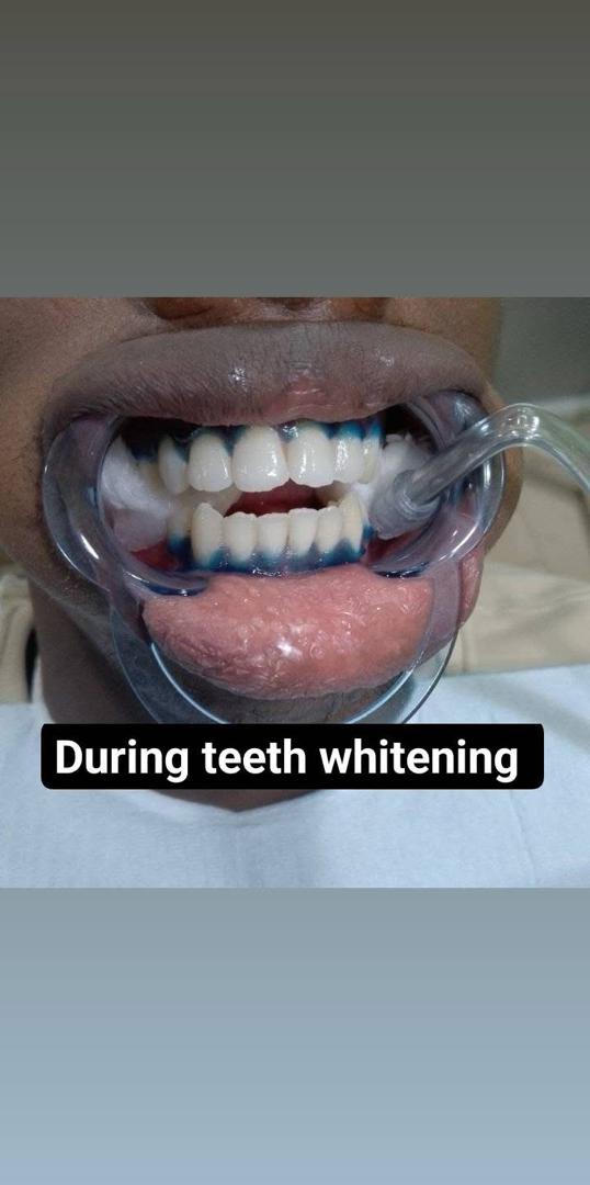 Professional Teeth Whitening – before