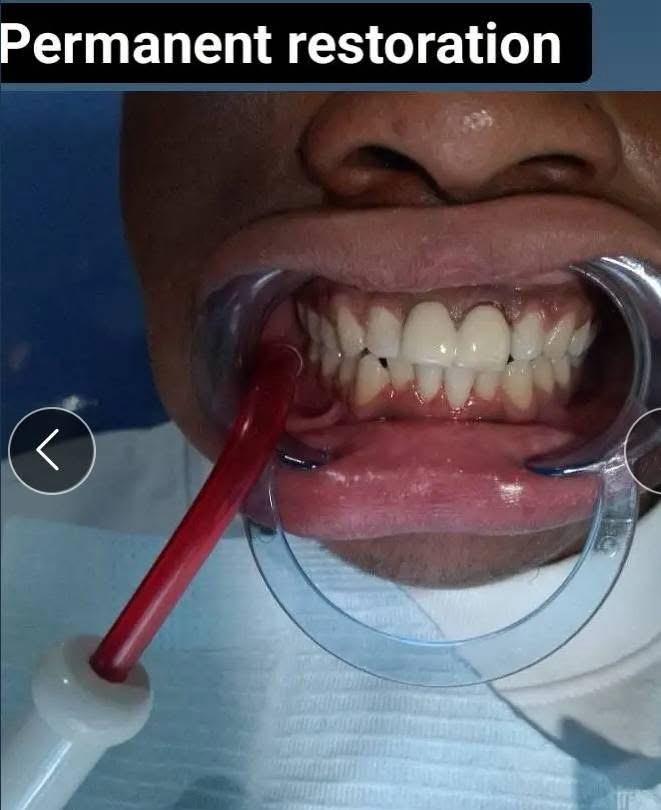 Front Tooth Reconstruction – after