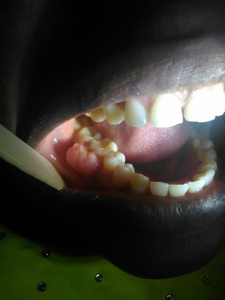 Minor Oral Surgery – before